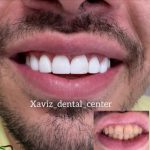 ونیر کامپوزیت دندان با ضمانت ، ایمپلنت ، دندانپزشکی